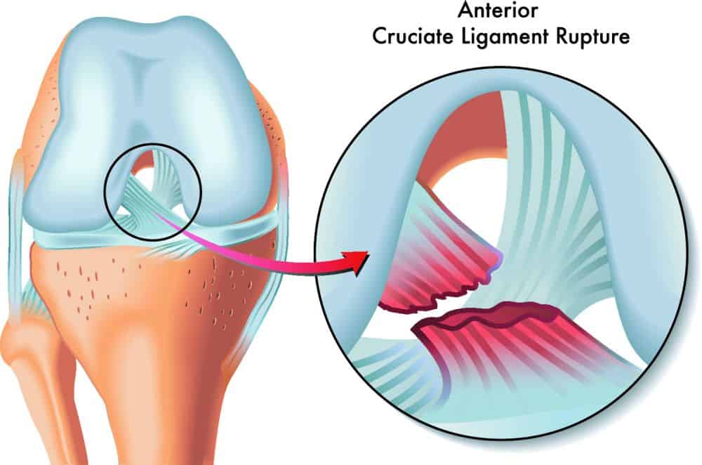 An ACL injury is a tear or sprain of the anterior cruciate ligament, one of the strong bands of tissue that help connect your thigh bone (femur) to your shinbone (tibia)