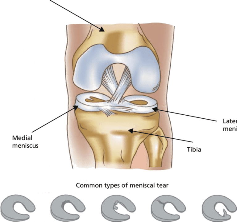 Menicus Compression Patterns Meniscal Tear - Have You Torn Your Meniscus? - Injury Health Blog
