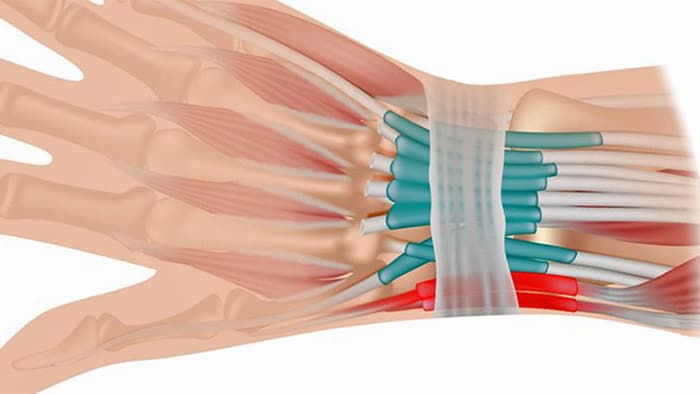 Wrist Tendonitis Symptoms And Treatment - Injury Health Blog